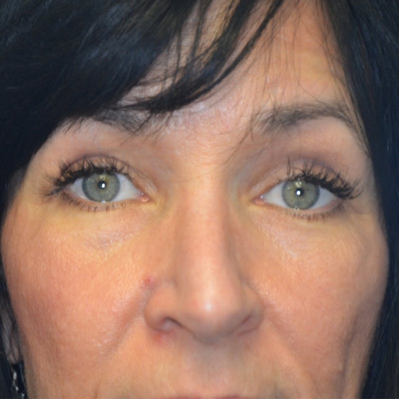 Upper Eyelid Surgery Before & After Gallery - Patient 114721165 - Image 2