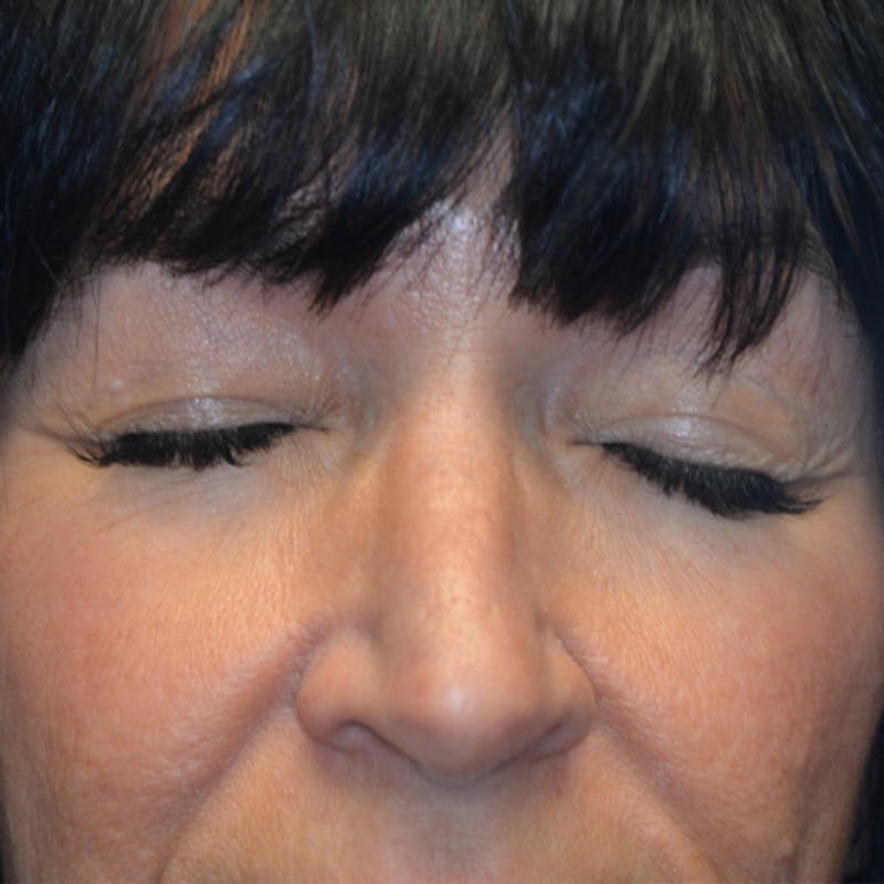 Upper Eyelid Surgery Before & After Gallery - Patient 114721165 - Image 3