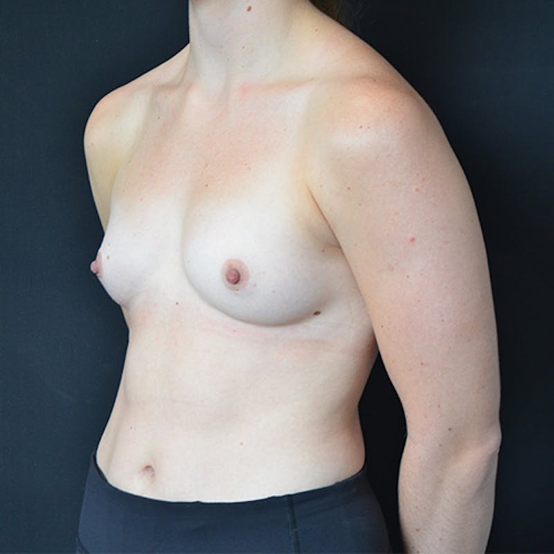 Breast Augmentation Before & After Gallery - Patient 114721163 - Image 9