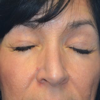 Upper Eyelid Surgery Before & After Gallery - Patient 114721165 - Image 4