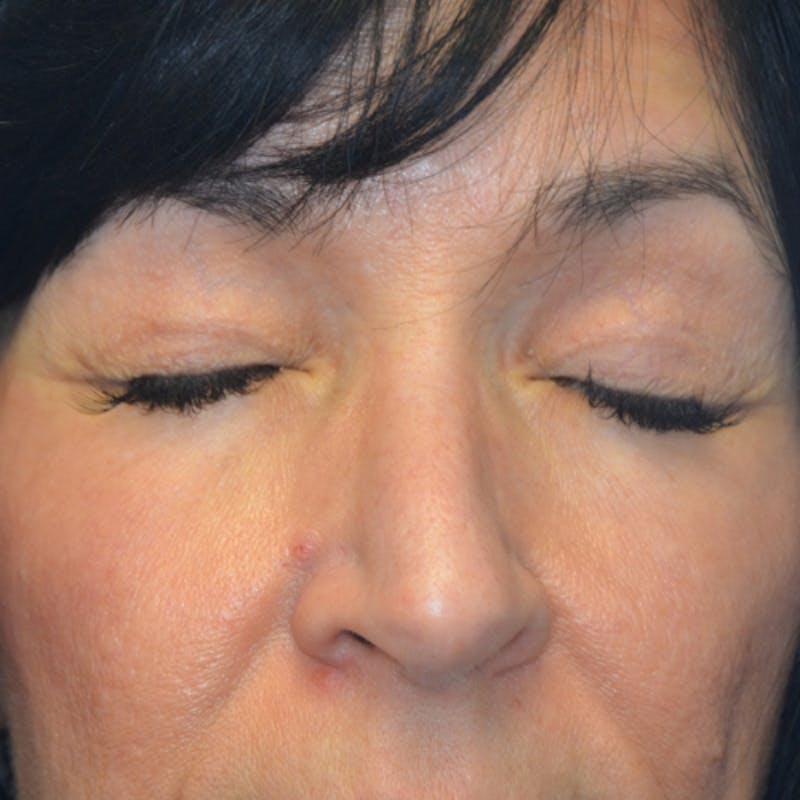 Upper Eyelid Surgery Before & After Gallery - Patient 114721165 - Image 4