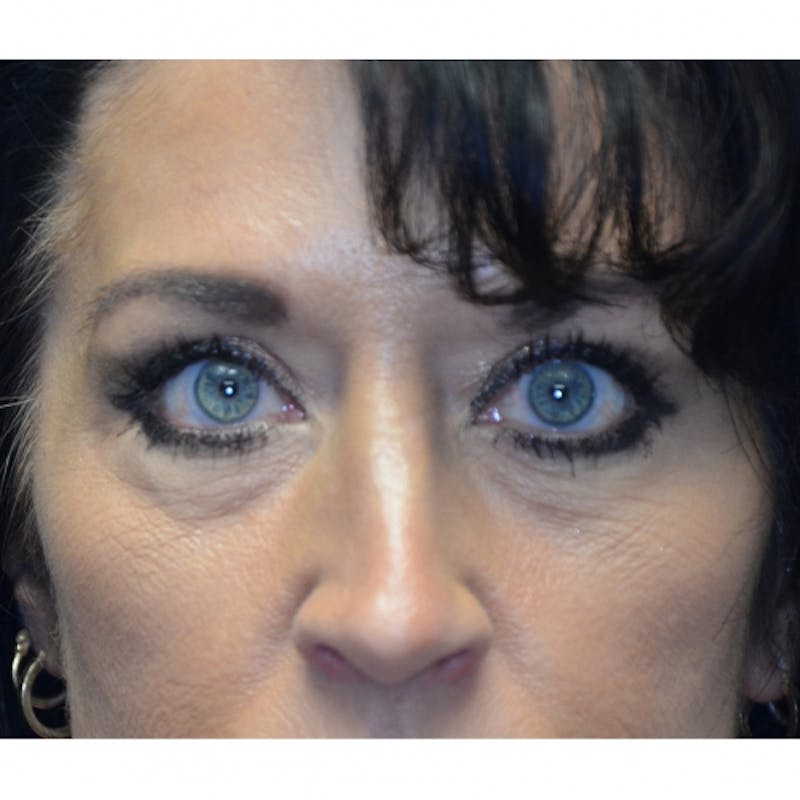 Lower Eyelid Surgery Before & After Gallery - Patient 118186865 - Image 1