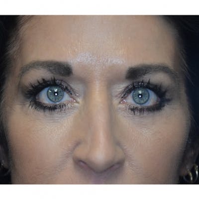 Lower Eyelid Surgery Before & After Gallery - Patient 118186865 - Image 2