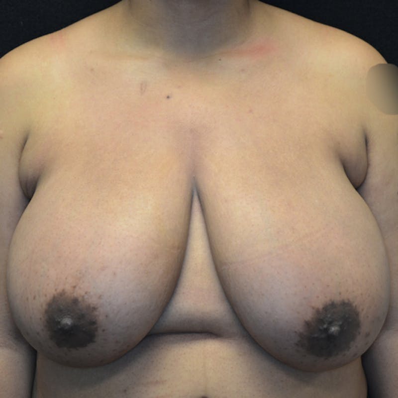 Breast Reduction Before & After Gallery - Patient 114721173 - Image 1