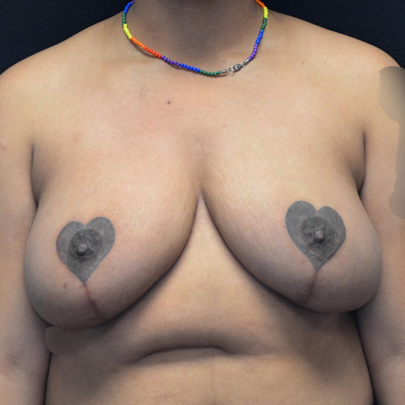 Breast Reduction Before & After Gallery - Patient 114721173 - Image 2