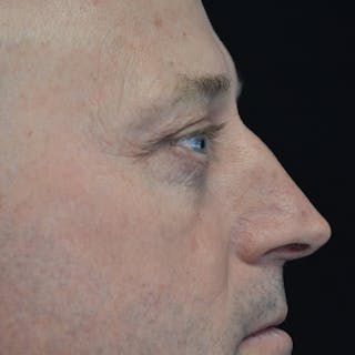 Lower Eyelid Surgery Before & After Gallery - Patient 118186866 - Image 4