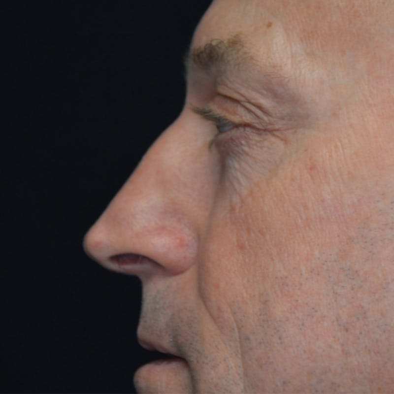 Lower Eyelid Surgery Before & After Gallery - Patient 118186866 - Image 6