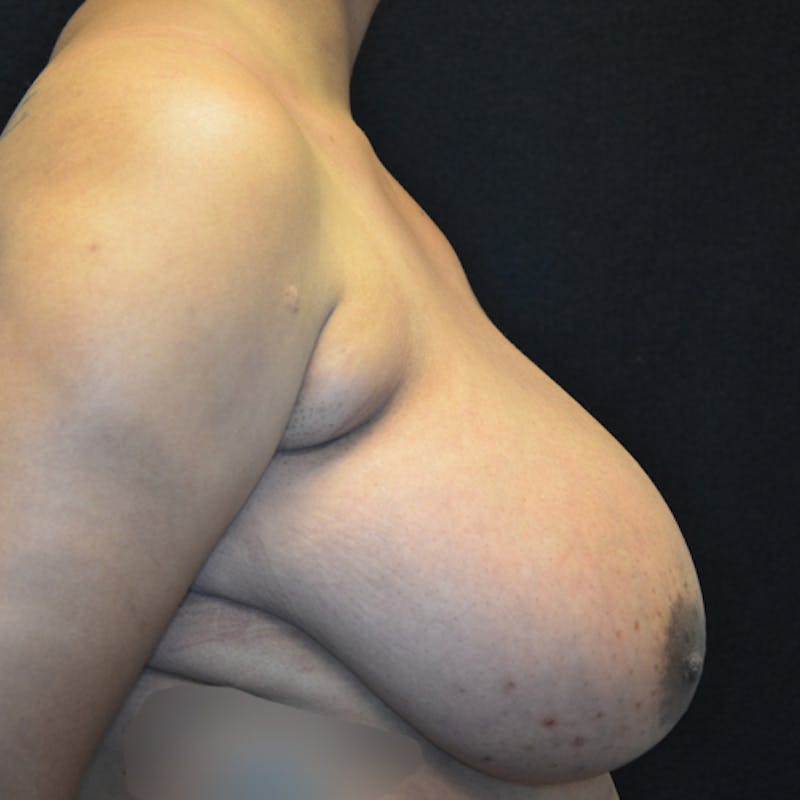 Breast Reduction Before & After Gallery - Patient 114721173 - Image 5