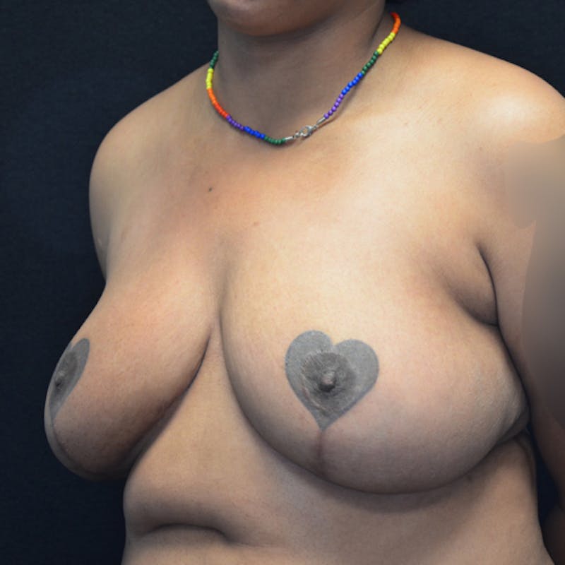 Breast Reduction Before & After Gallery - Patient 114721173 - Image 8