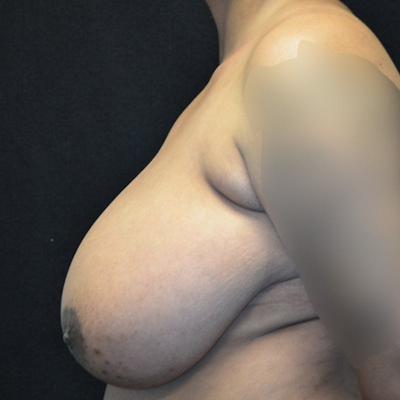 Breast Reduction Before & After Gallery - Patient 114721173 - Image 9