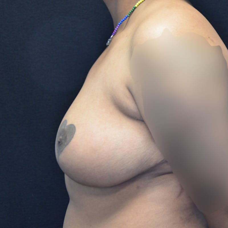 Breast Reduction Before & After Gallery - Patient 114721173 - Image 10