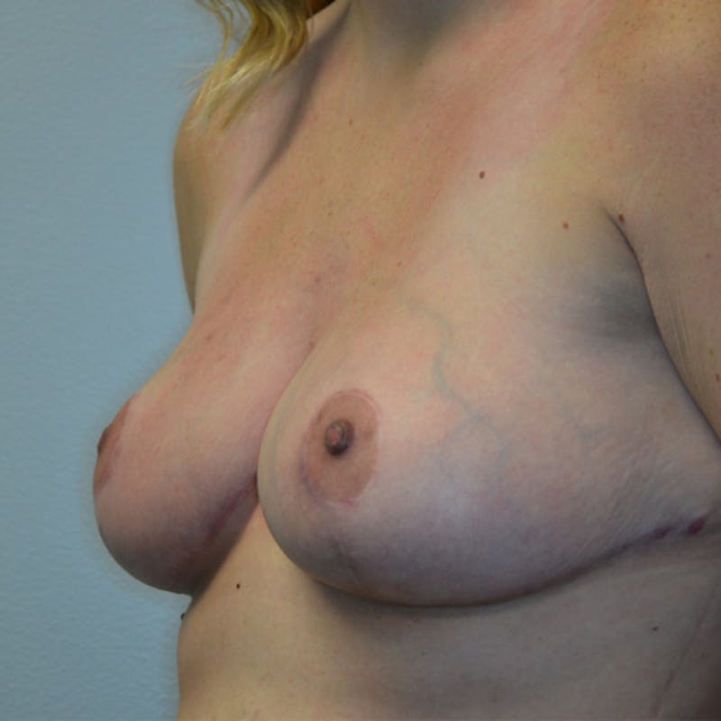 Breast Reduction Before & After Gallery - Patient 114721179 - Image 8