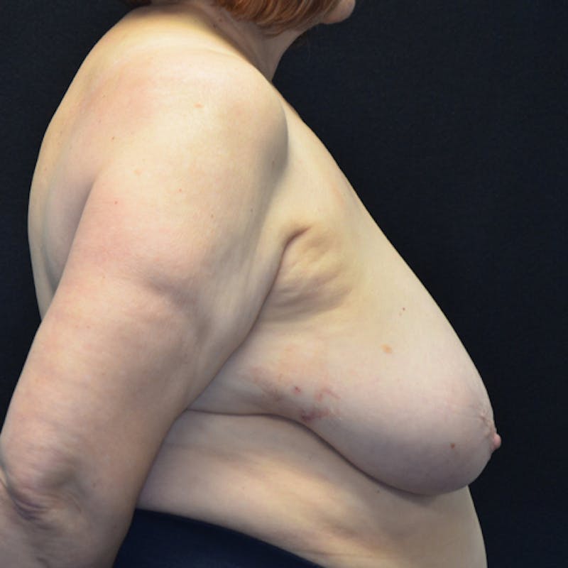Breast Reduction Before & After Gallery - Patient 114721190 - Image 5