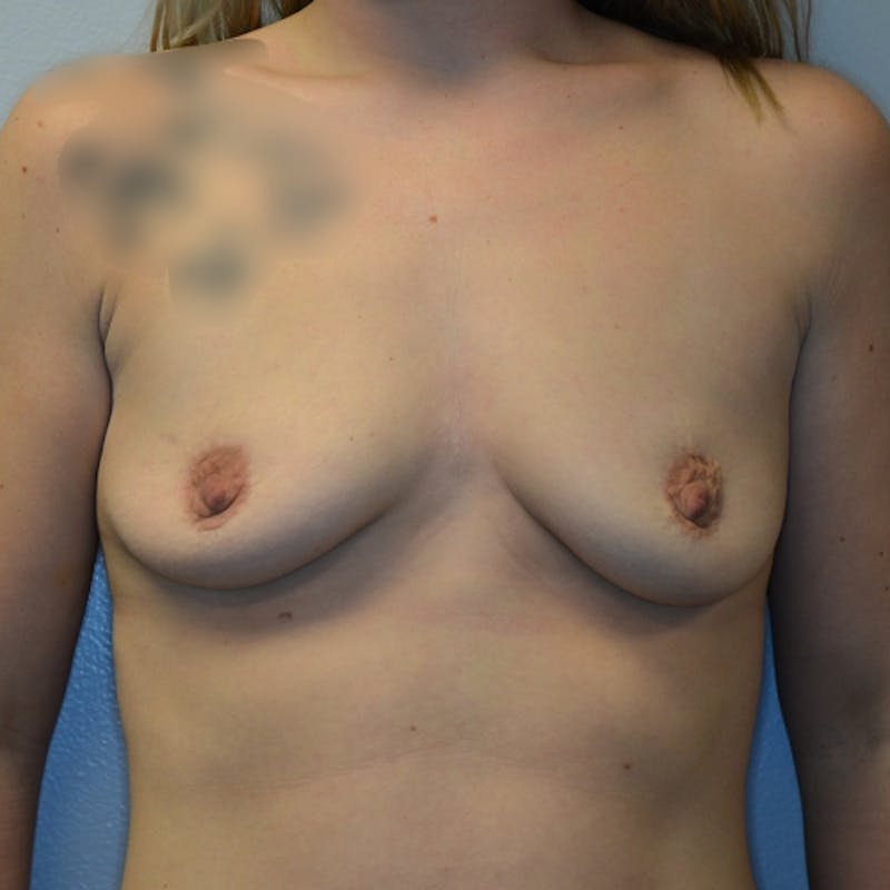 Breast Augmentation Before & After Gallery - Patient 115351362 - Image 1