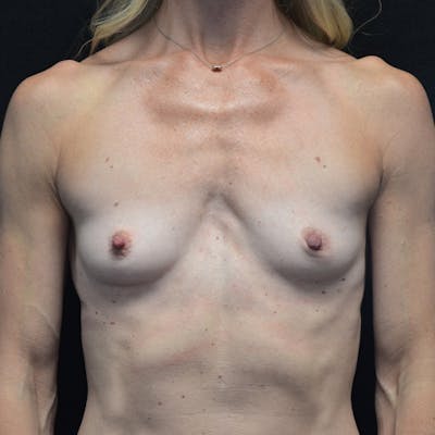 Breast Augmentation Before & After Gallery - Patient 115351372 - Image 1