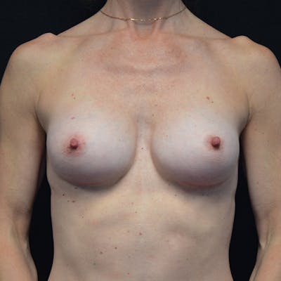 Breast Augmentation Before & After Gallery - Patient 115351372 - Image 2