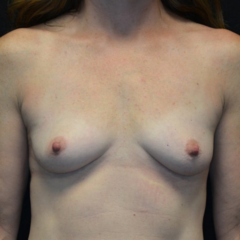 Breast Augmentation Before & After Gallery - Patient 115351373 - Image 1