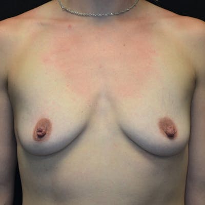 Breast Augmentation Before & After Gallery - Patient 115351374 - Image 1
