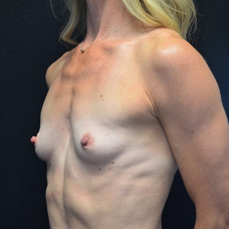 Breast Augmentation Before & After Gallery - Patient 115351372 - Image 5