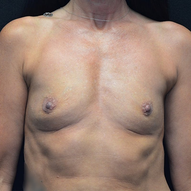 Breast Augmentation Before & After Gallery - Patient 115351376 - Image 1