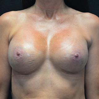Breast Augmentation Before & After Gallery - Patient 115351376 - Image 2