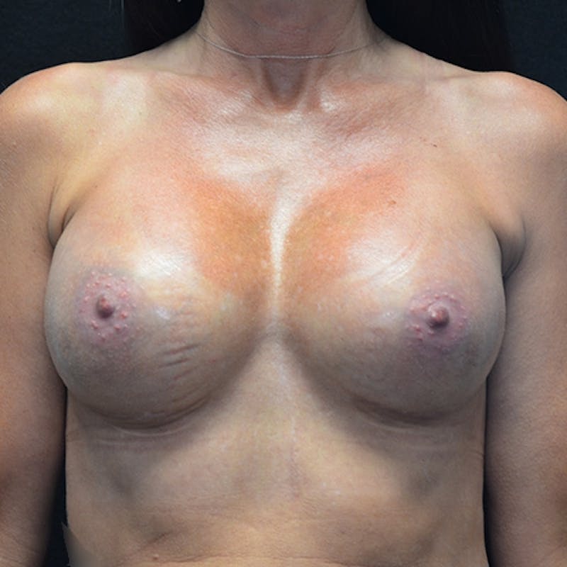 Breast Augmentation Before & After Gallery - Patient 115351376 - Image 2
