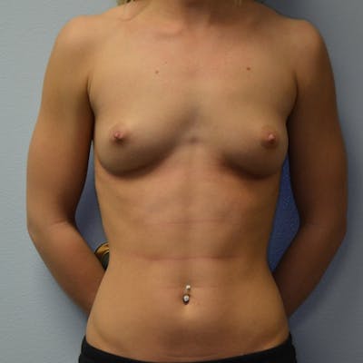 Breast Augmentation Before & After Gallery - Patient 115351375 - Image 1