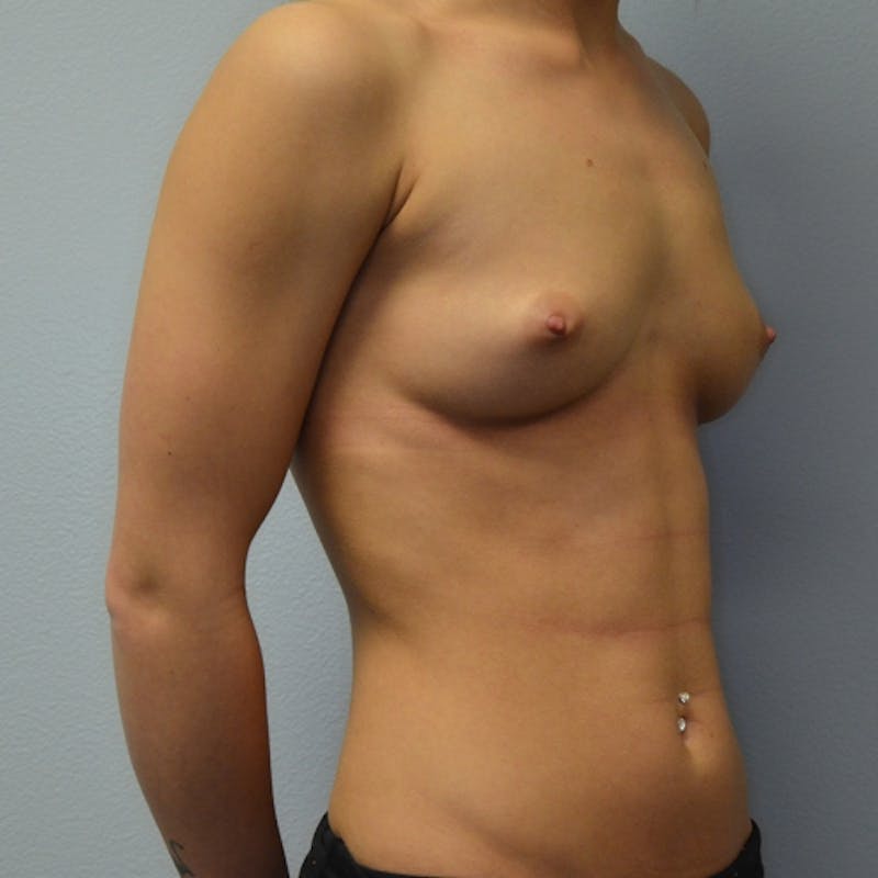 Breast Augmentation Before & After Gallery - Patient 115351375 - Image 3