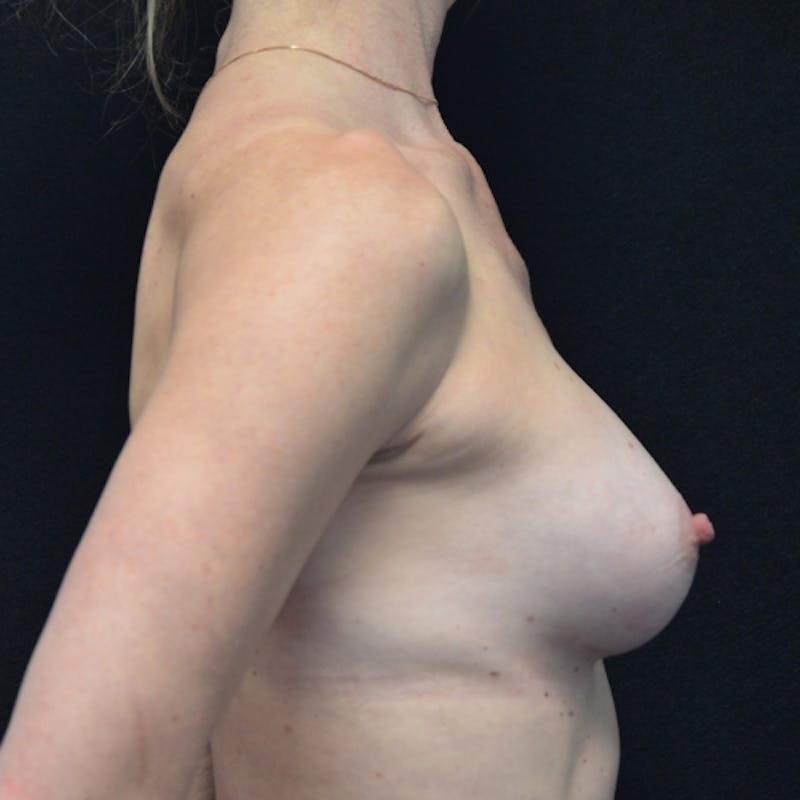 Breast Augmentation Before & After Gallery - Patient 115351372 - Image 10