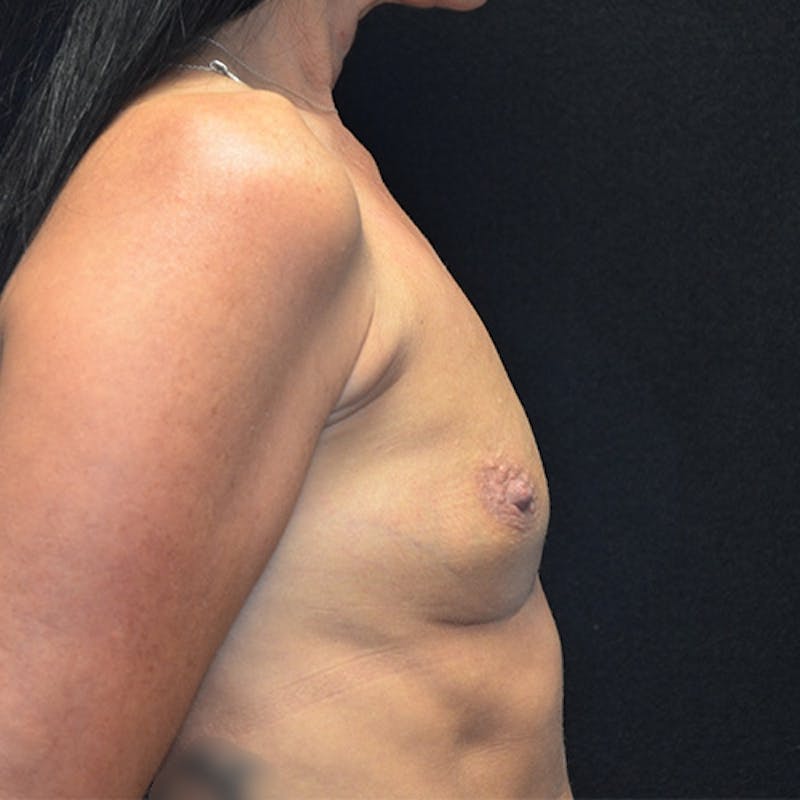 Breast Augmentation Before & After Gallery - Patient 115351376 - Image 5