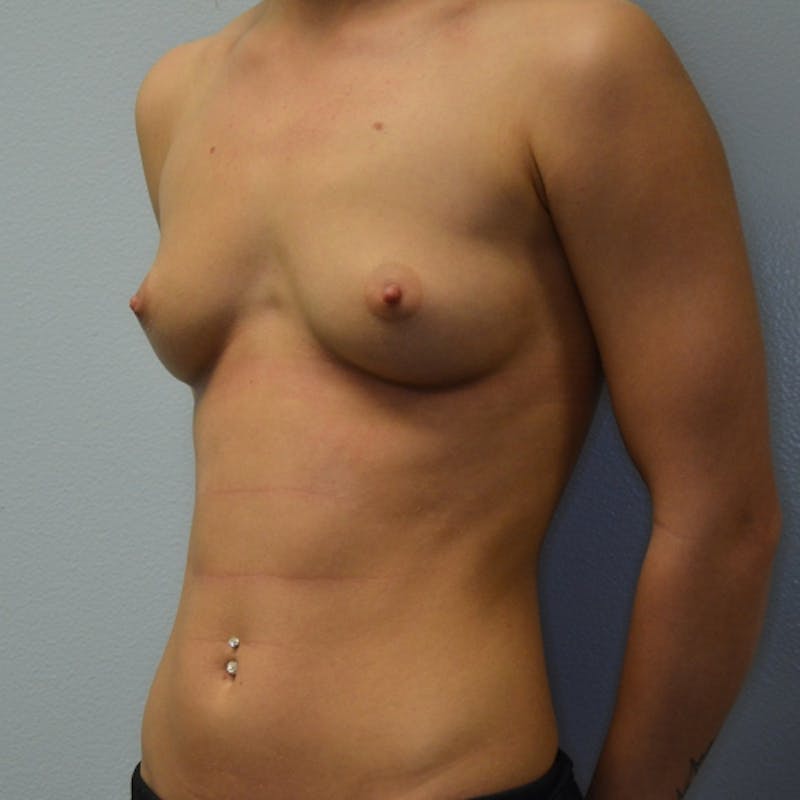 Breast Augmentation Before & After Gallery - Patient 115351375 - Image 5