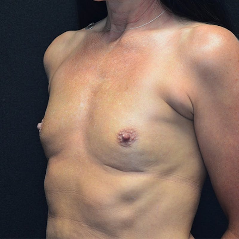 Breast Augmentation Before & After Gallery - Patient 115351376 - Image 7