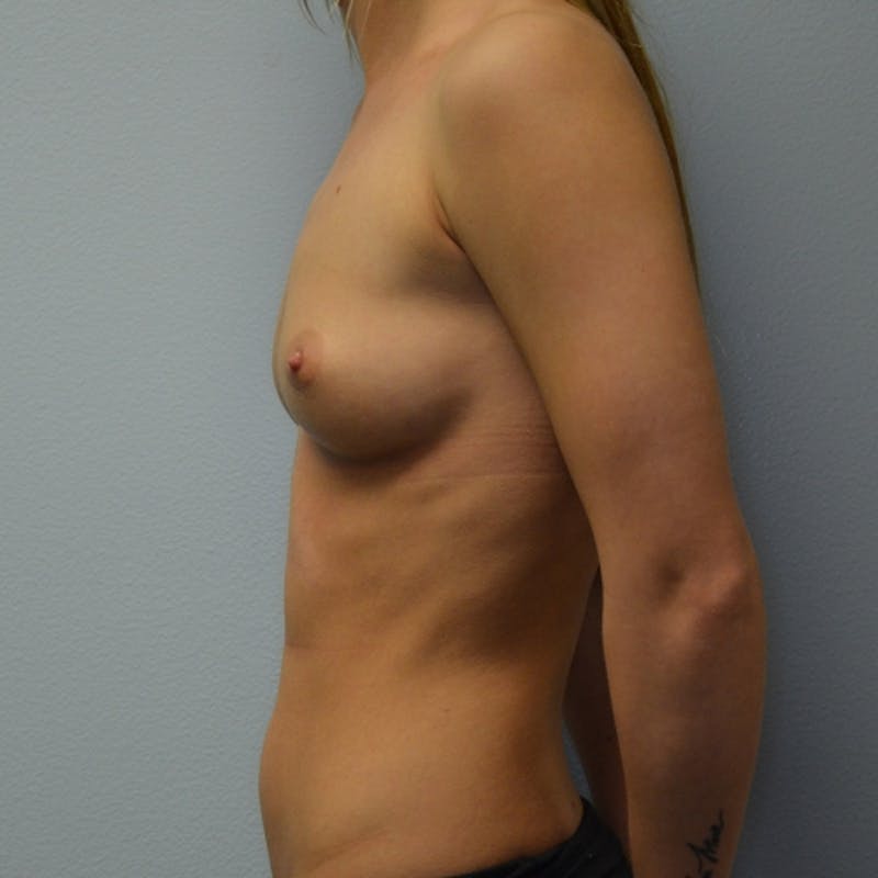 Breast Augmentation Before & After Gallery - Patient 115351375 - Image 7