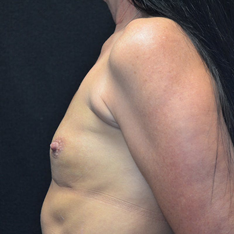 Breast Augmentation Before & After Gallery - Patient 115351376 - Image 9