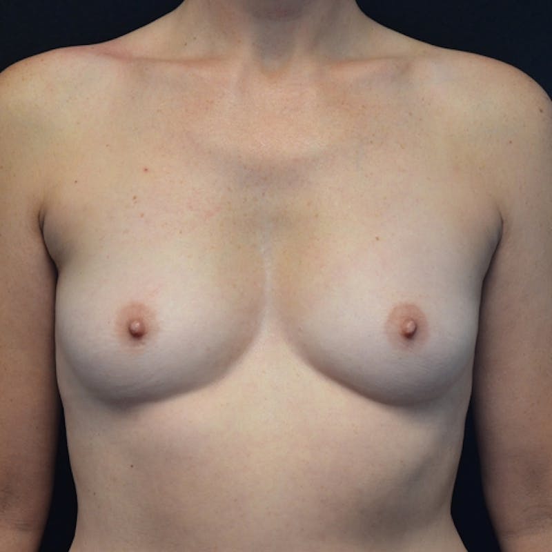Breast Augmentation Before & After Gallery - Patient 115351390 - Image 1