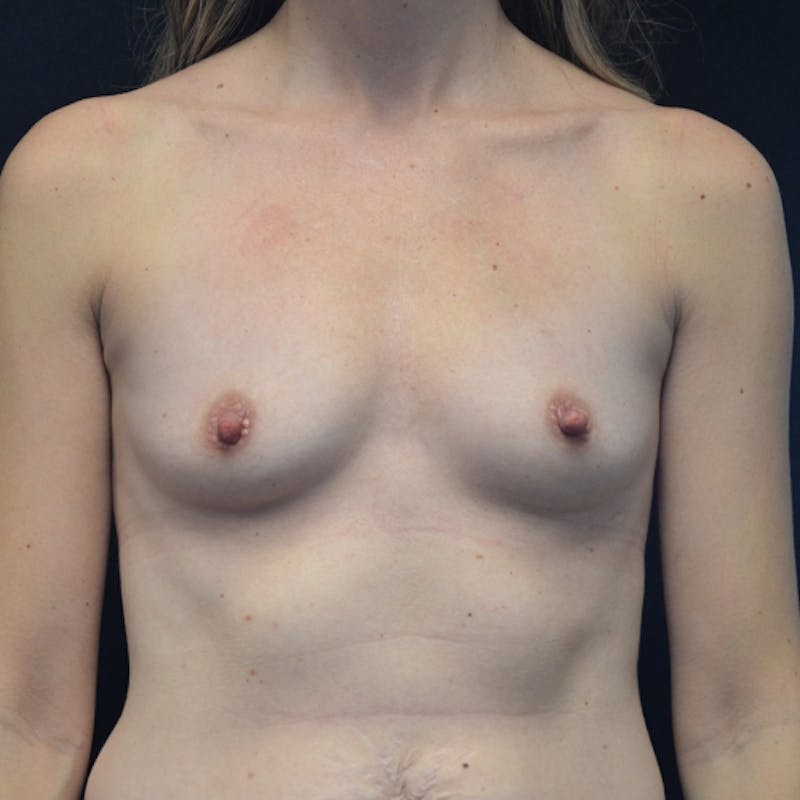 Breast Augmentation Before & After Gallery - Patient 115351393 - Image 1