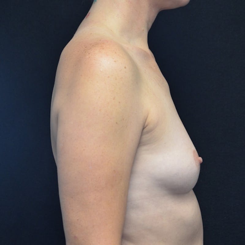 Breast Augmentation Before & After Gallery - Patient 115351390 - Image 7