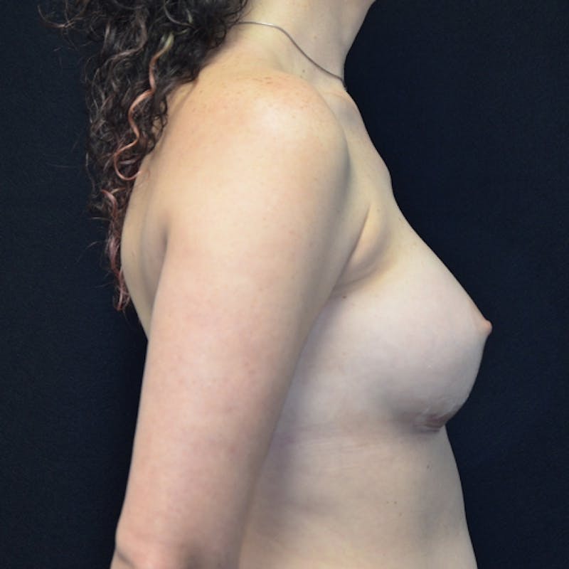 Breast Augmentation Before & After Gallery - Patient 115351390 - Image 8