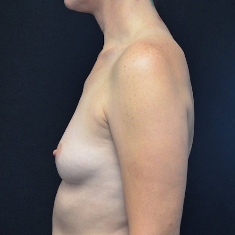 Breast Augmentation Before & After Gallery - Patient 115351390 - Image 9