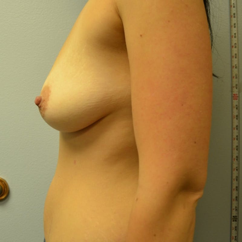 Breast Augmentation Before & After Gallery - Patient 115351391 - Image 9