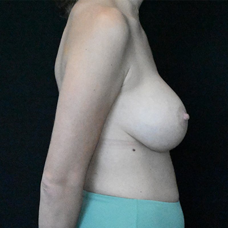 Breast Revision Before & After Gallery - Patient 115351713 - Image 7