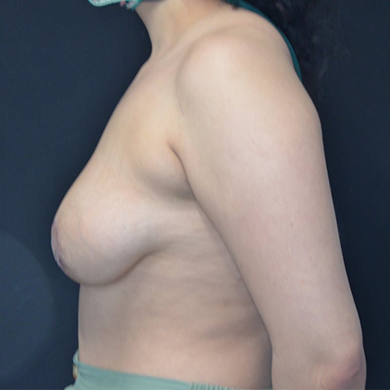 Breast Revision Before & After Gallery - Patient 115351726 - Image 8