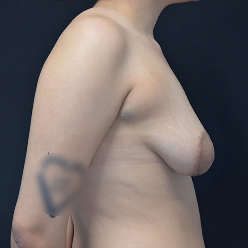 Breast Revision Before & After Gallery - Patient 115351726 - Image 9