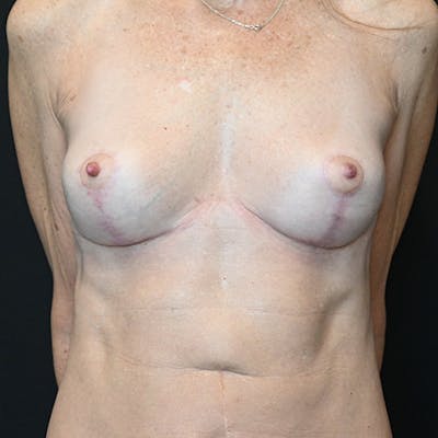 Breast Revision Before & After Gallery - Patient 115351749 - Image 2