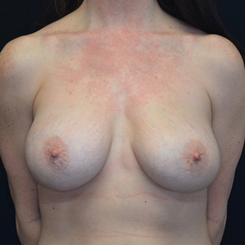 Breast Revision Before & After Gallery - Patient 115351783 - Image 1
