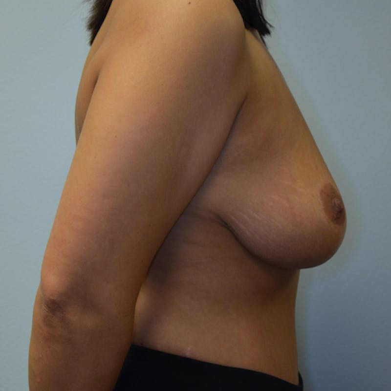 Breast Revision Before & After Gallery - Patient 115351801 - Image 5