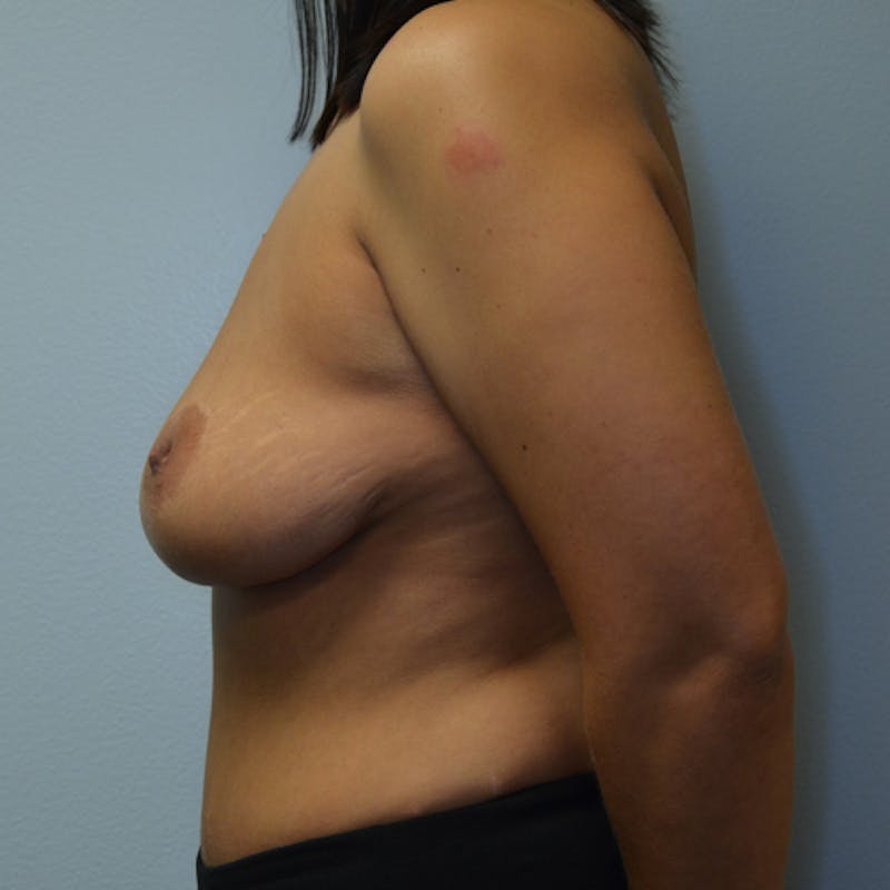 Breast Revision Before & After Gallery - Patient 115351801 - Image 9