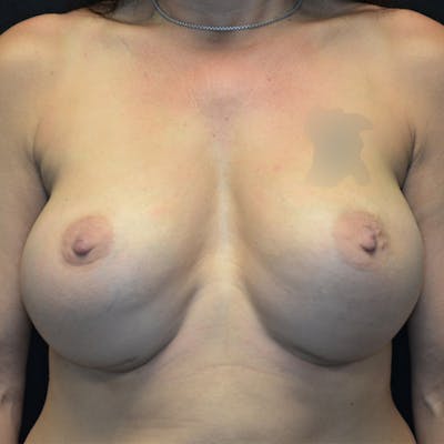 Breast Revision Before & After Gallery - Patient 115351818 - Image 1