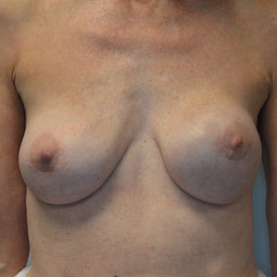 Breast Revision Before & After Gallery - Patient 115351824 - Image 1