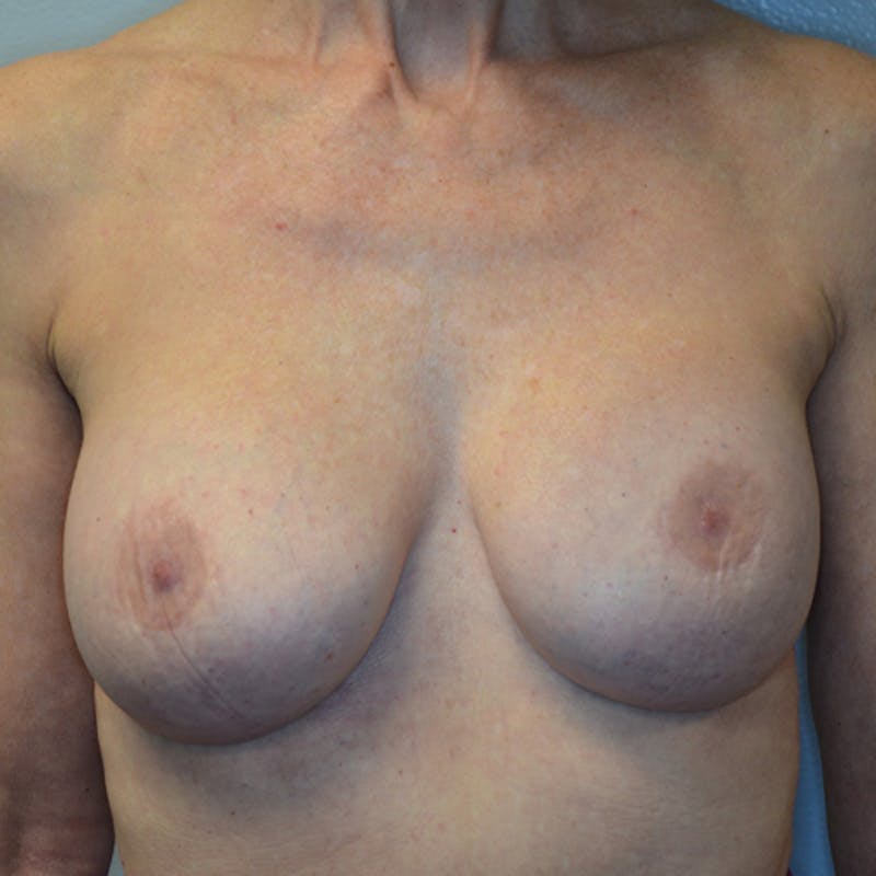 Breast Revision Before & After Gallery - Patient 115351824 - Image 2